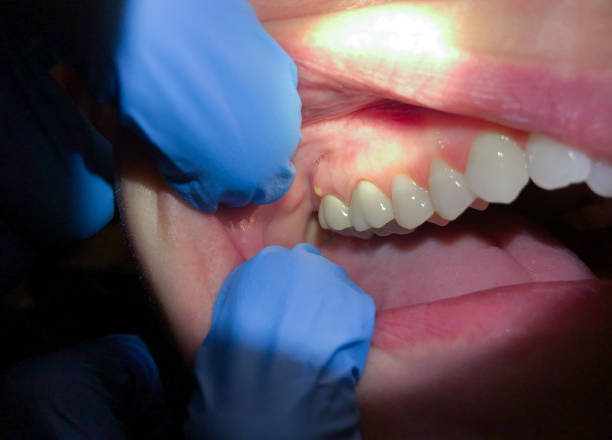 Best Emergency Wisdom Teeth Removal in Teviston, CA