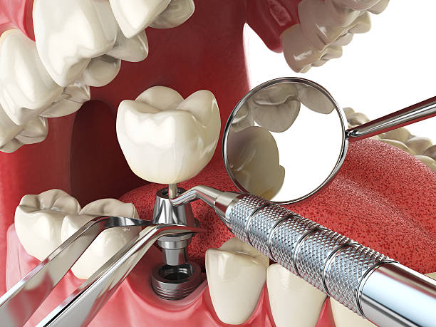 Best Urgent Care for Lost Fillings or Crowns in Teviston, CA